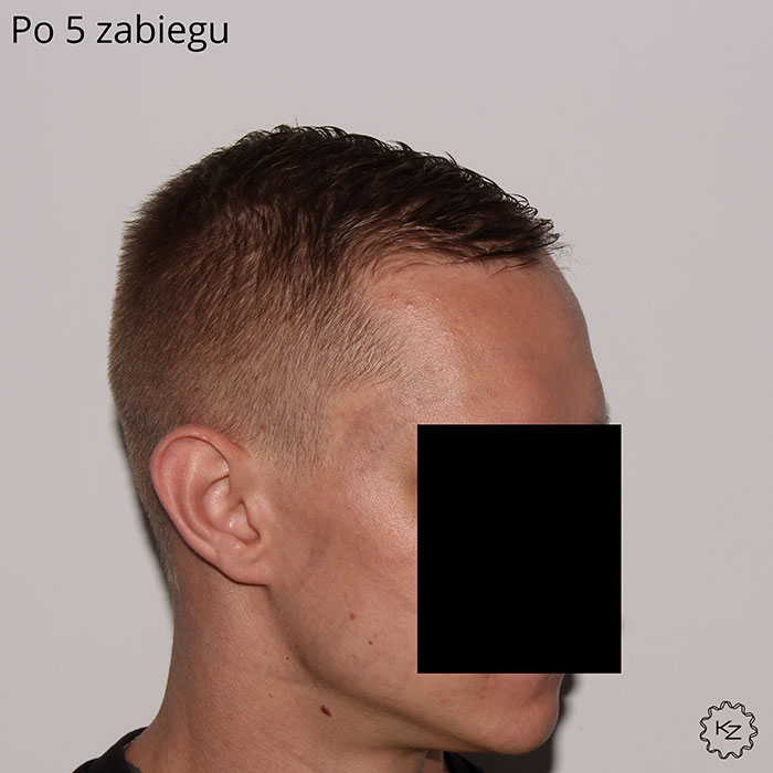 usuwanie tatuażu efekt